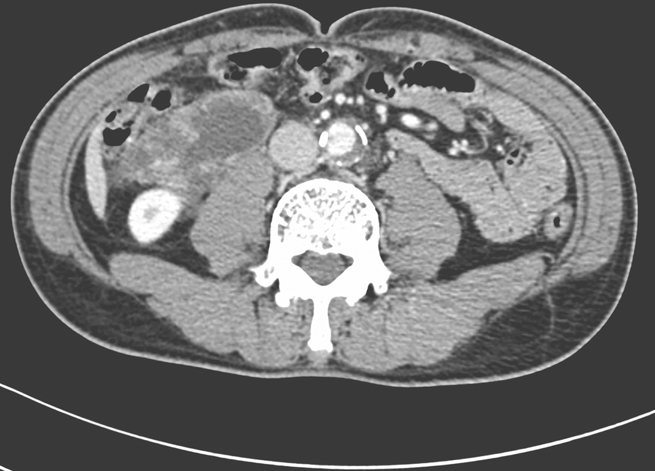 图3 服药8个月后腹部增强CT